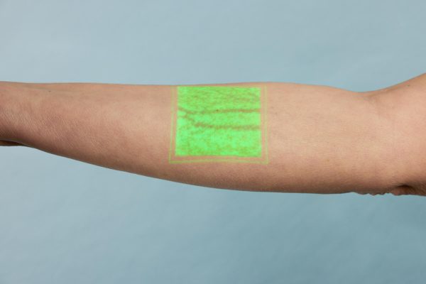 AccuVein Vein Visualization System