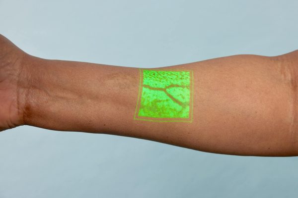 AccuVein Vein Visualization System