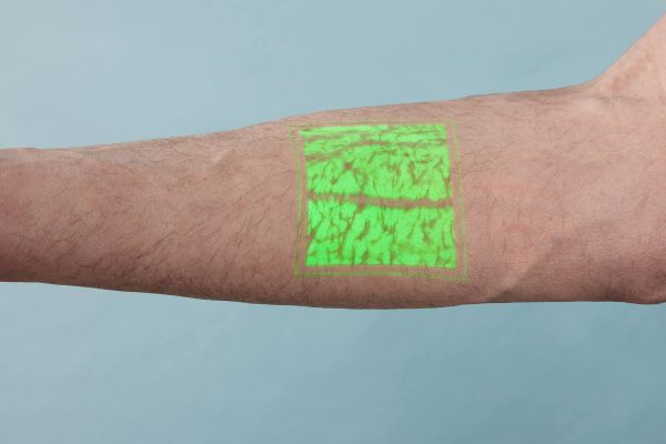 AccuVein Vein Visualization System